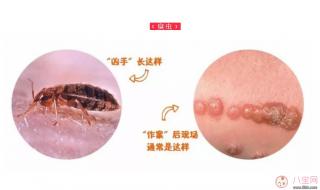 隐翅虫咬人后图片 隐翅虫咬人后图片
